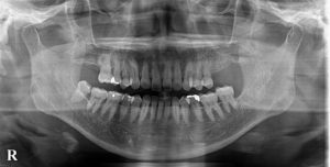 ショートインプラントを利用し上顎洞底挙上術を回避した症例
